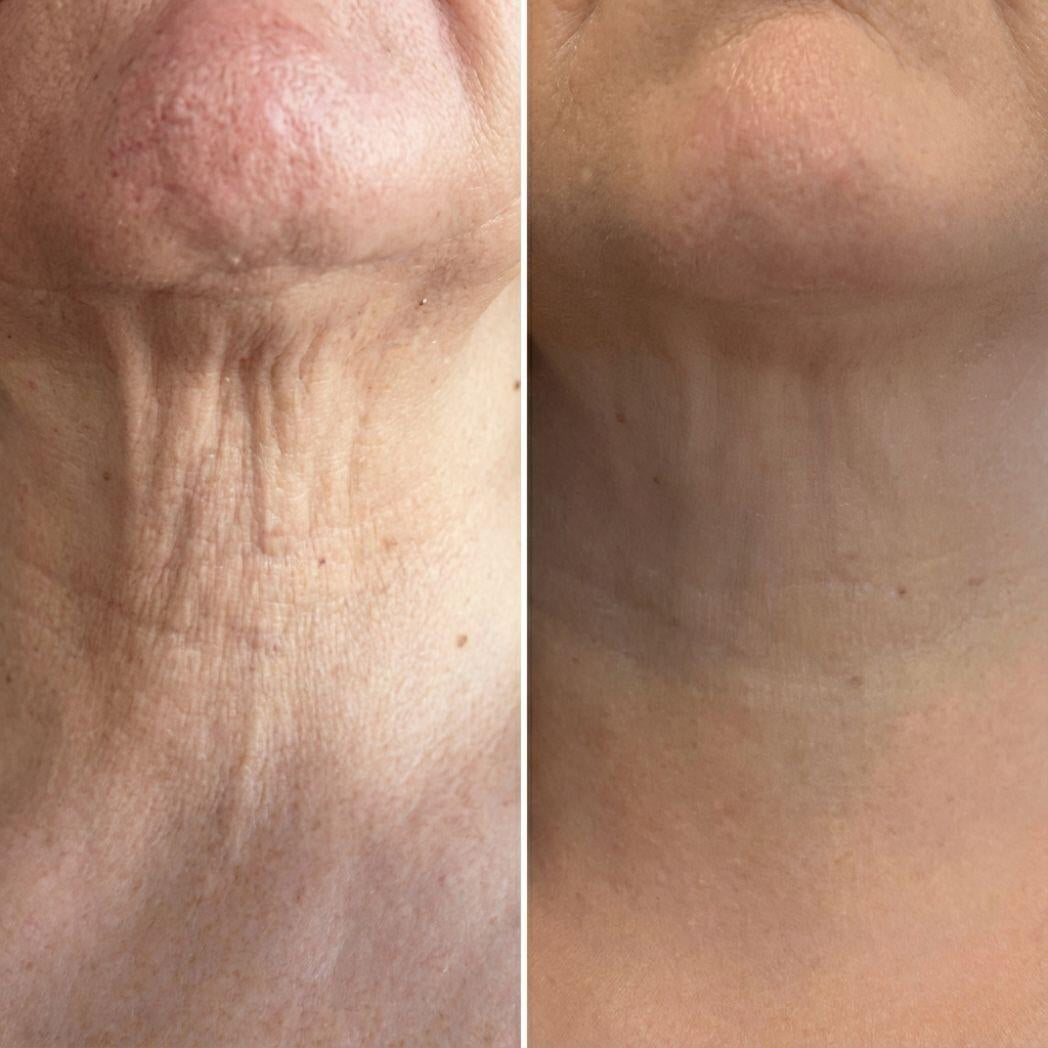 Crema con Masajeador 3D para Cuello